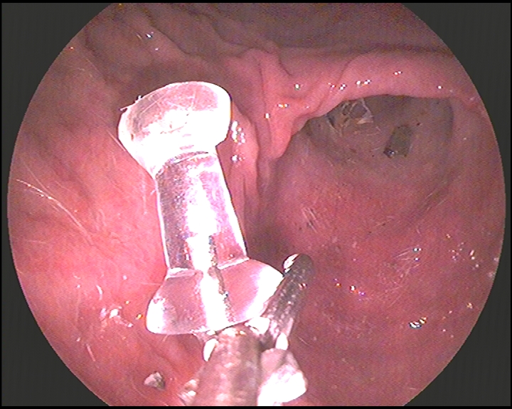 Push-pin retrieved with endoscope