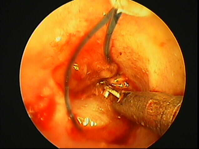 Endoscopic surgical removal of an ear polyp in a cat