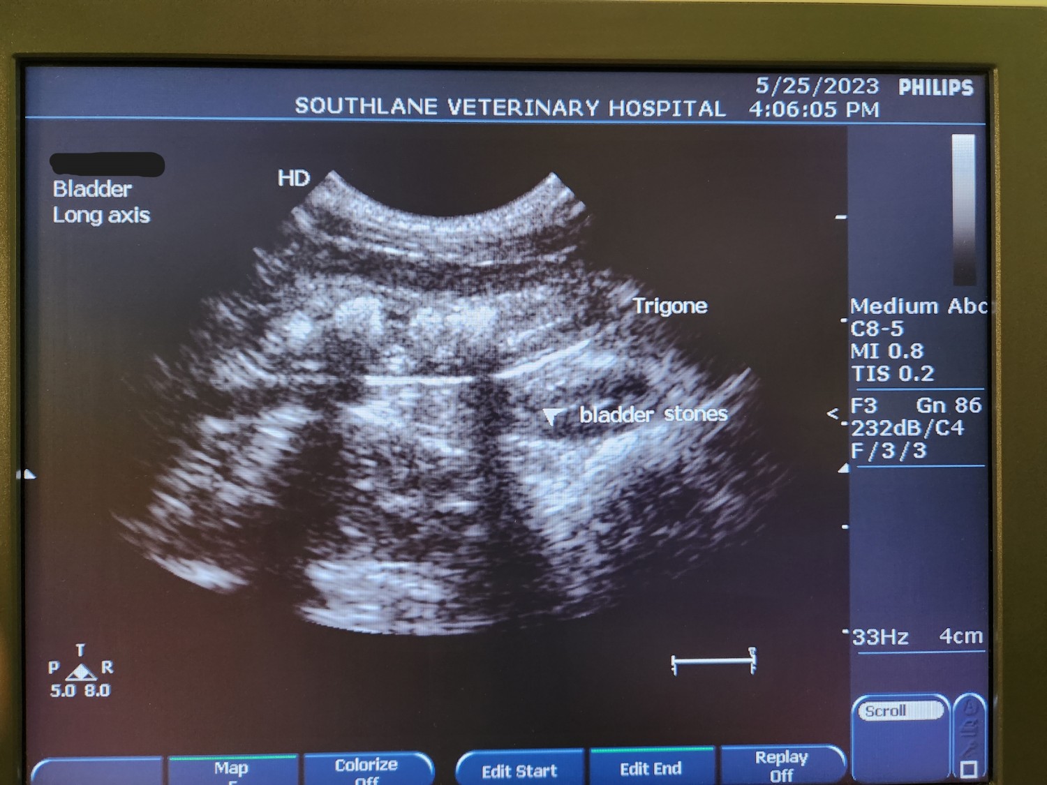 Multiple bladder stones